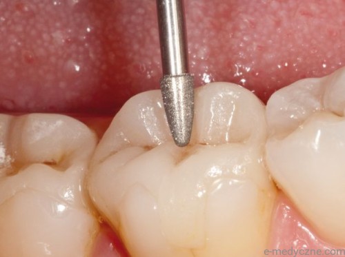 Wiertła do guzków 972